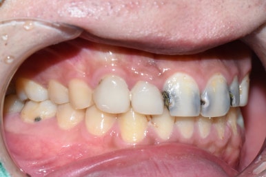 시청역치과 치아가 부러졌어요 치아가 너무 많이 썩어서 앞니가 거의 없는 치아의 크라운 케이스 관련 이미지 2