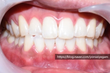 커피많이드세요? 치과에서 하는 치아미백 알려드려요[효과, 유지 등등 실제사례] 관련 이미지 9