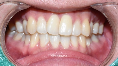 해외에서도 찾아오는 앞니레진치료, 광화문 시청역 서울역 근처 연세예감치과 외국인도 찾는 이유 관련 이미지 10