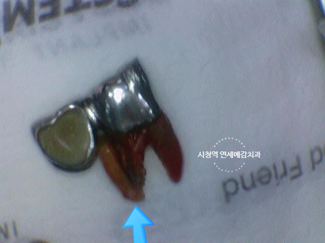 [서울역/치과] 고기 뼈를 씹고 치아가 부러졌어요 관련 이미지 11