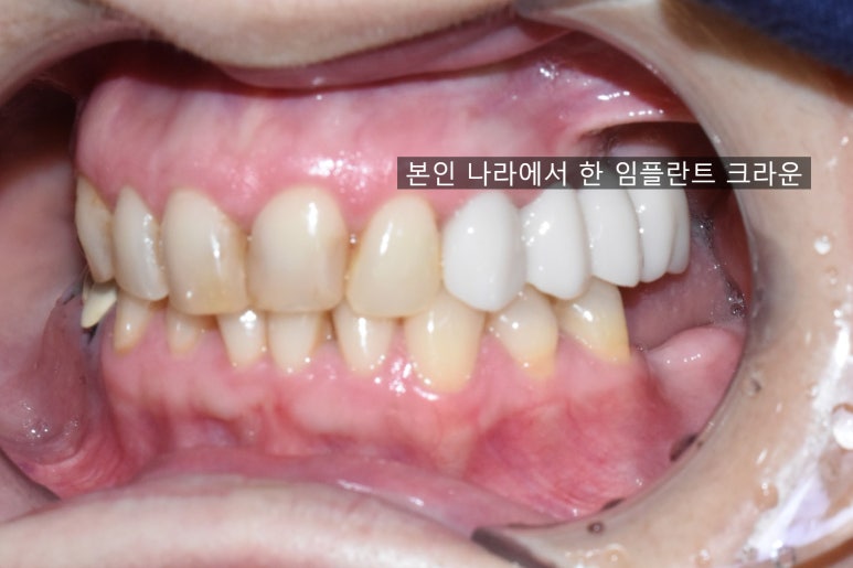 치아를 하얗게 하고 싶은 캐나다에서 오신 환자분의 라미네이트 사진공개이벤트진행중 관련 이미지 2