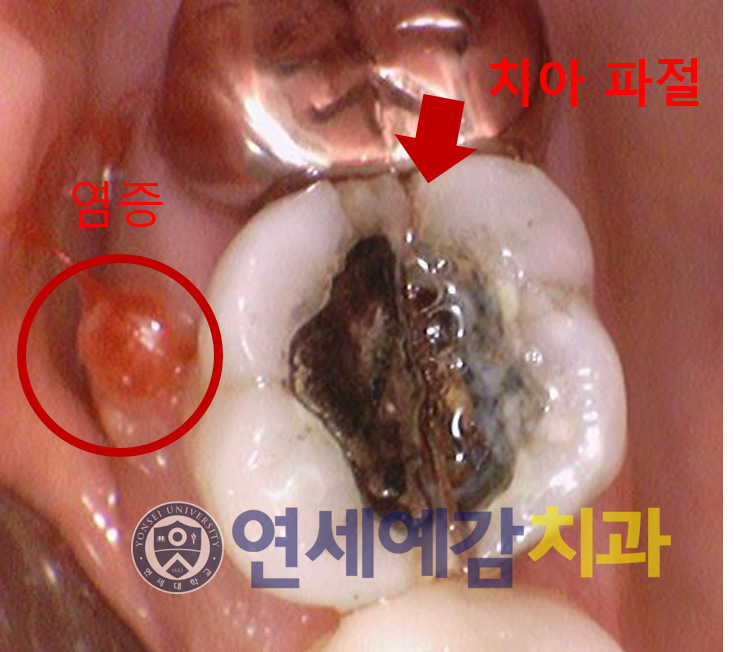시청역치과 시청치과 자연치아살리기 <연세예감치과> 관련 이미지 3
