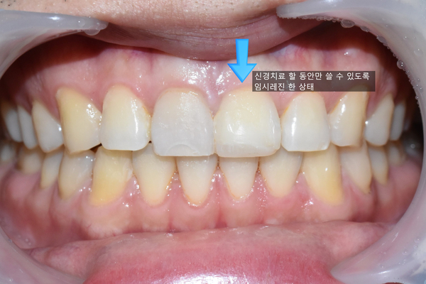 앞니깨짐 실제 치료 사례, 넘어져서 변색된 앞니 깨진 앞니 관련 이미지 6