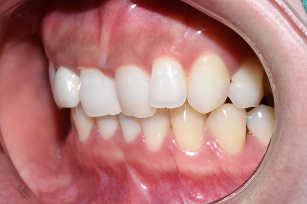 [시청역/광화문]옥니 무삭제라미네이트 전후 소개 및 이벤트 가격안내 관련 이미지 1