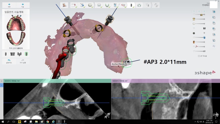 [남대문시장] 임플란트 조금 더 안아프고 간편하게 관련 이미지 7