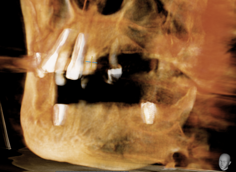 사용중인 틀니가 불편하다면? 임플란트와 틀니가 결합된 임플란트 틀니 추천 관련 이미지 22