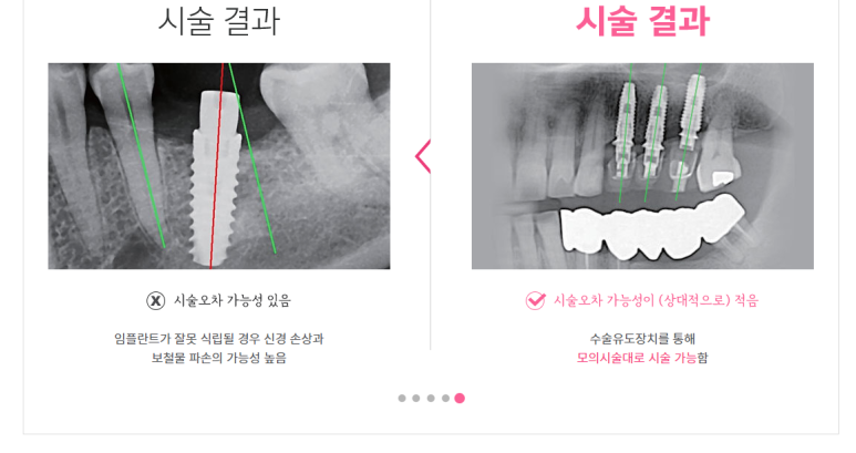 시청역 광화문  최소절개 또는 비절개로 가능한 네비게이션 임플란트 유명한 치과 내비게이션소개드려요 관련 이미지 4