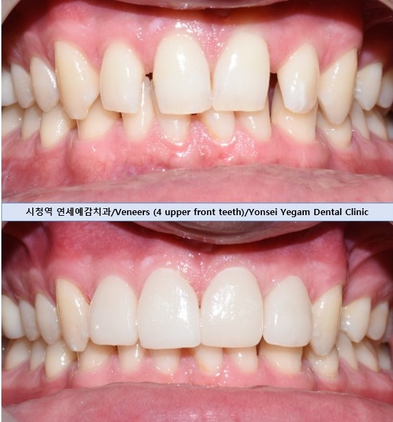 왜소치 치아사이틈 막기 올해는 치료받으세요! [무삭제라미네이트 케이스] 관련 이미지 8