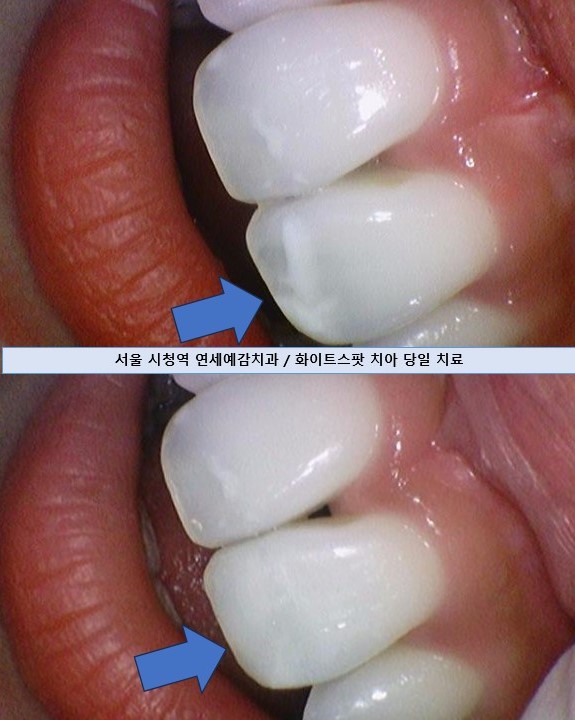 반상치 화이트스팟 외국인들도 치료받으러 오는 광화문 연세예감치과 관련 이미지 2