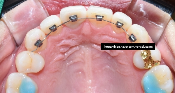 Q&A:"교정을 예전에 오래전에 했는데 앞니치아가 삐뚤어졌어요"해결방법은, 비용은? 관련 이미지 5