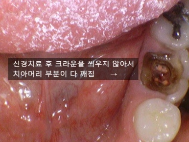 [서울/시청역]어금니 치아가 깨져서 크라운이 필요하다면? 관련 이미지 3