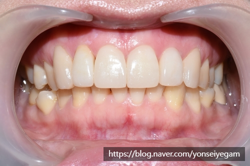 [시청역/광화문/서대문]삐뚤삐뚤한 치아 무삭제라미네이트로 치아성형 관련 이미지 8