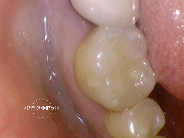 충정로 / 금니, 금크라운, 금인레이,아말감 치아가 보기 싫다면? 치아색 이맥스 인레이,지르코니아 크라운 소개 관련 이미지 3