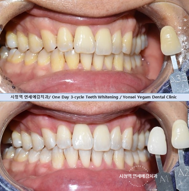 치아미백 시림? 해외관광객 외국인들도 미백하러 찾아오는 치과에서 알려드립니다 관련 이미지 4