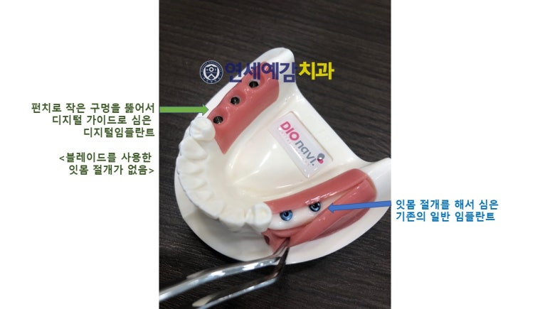 [서울시청역치과] 20대, 30대도 임플란트를 하나요?? +네비게이션임플란트안내 관련 이미지 4
