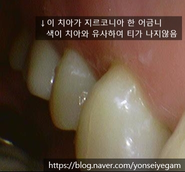 시청역치과 [Q&A]다른치과에서 한 인레이,크라운,임플란트에 음식물이 껴요 관련 이미지 7