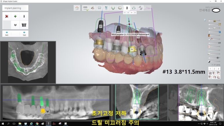 시청역 광화문  최소절개 또는 비절개로 가능한 네비게이션 임플란트 유명한 치과 내비게이션소개드려요 관련 이미지 10