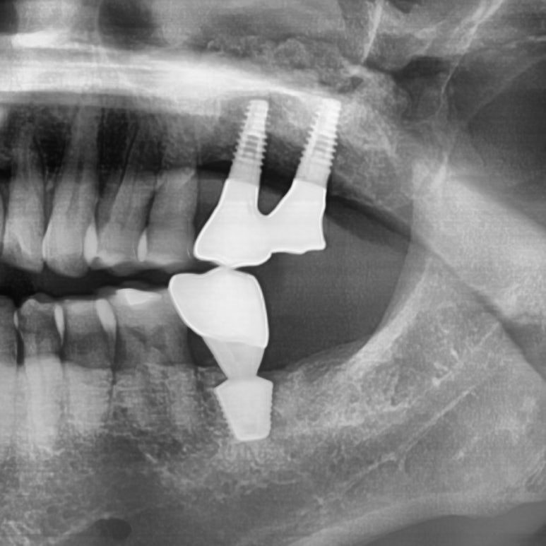 [서울시청역치과] 다른 치과에서 오래전에 한 임플란트가 흔들려요 &rarr;재수술 케이스 관련 이미지 1
