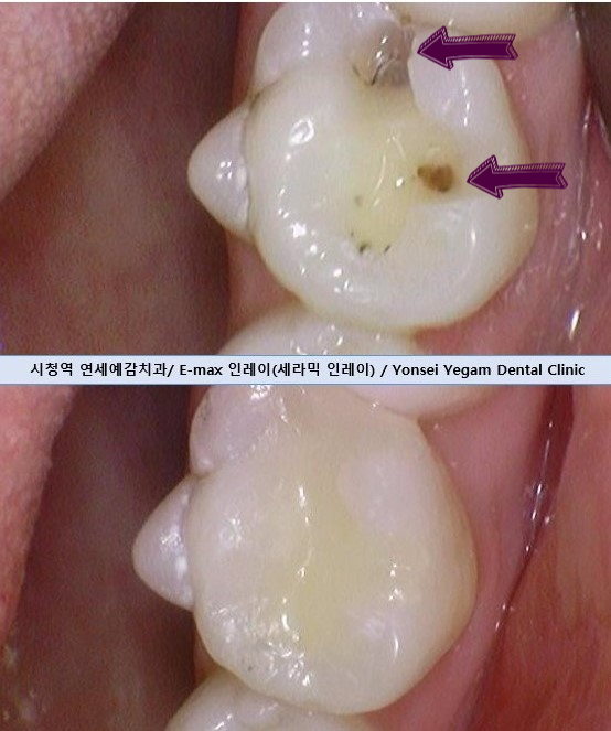 서울 인레이 유명한 치과 서울시청역치과 인레이에 대해 안내해드려요 관련 이미지 4