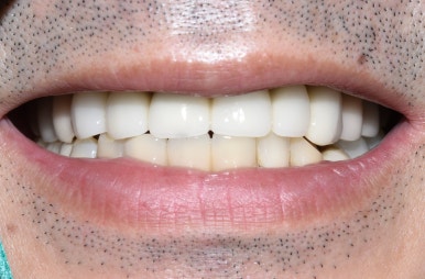 서울 중구 치과/이가 하나도 없는 환자의 치료방법/틀니, 풀아치임플란트, 전체 임플란트 등 관련 이미지 14