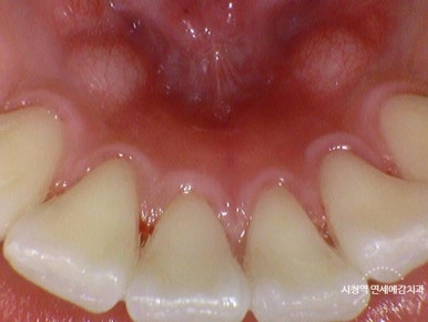 서울역 설날 설 전에 준비 해야 할 것들 스케일링이나 치아미백 어떠세요? 관련 이미지 2