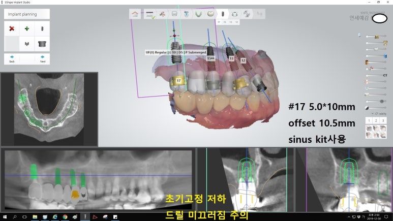 [북창동 치과/연세예감치과]내비게이션임플란트소개 관련 이미지 22