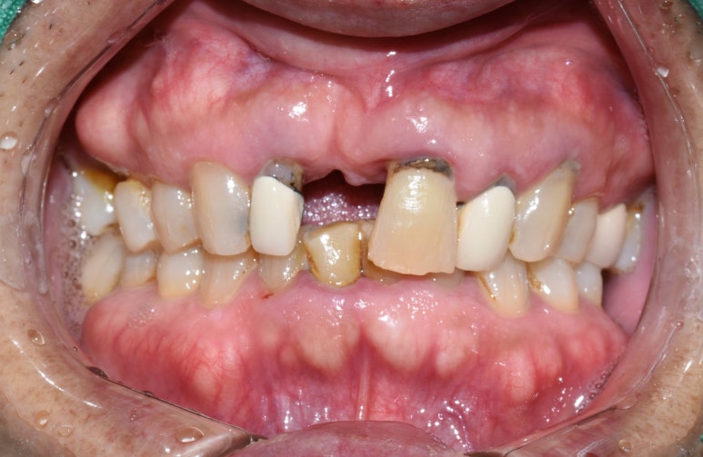 [서울시청역/서울역] 앞니 임플란트 가능할까요? 앞니 내비게이션임플란트 관련 이미지 3
