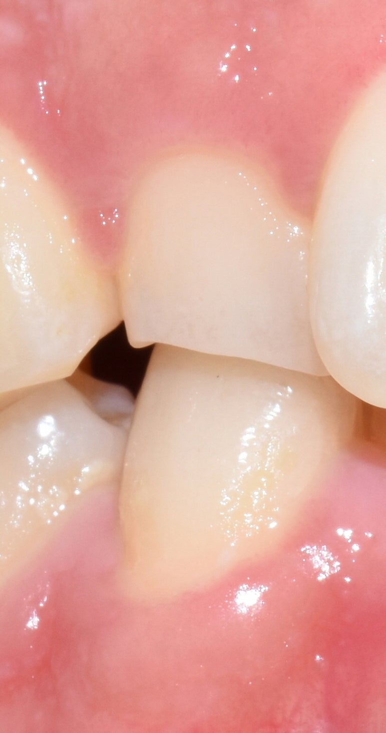 [서울역/광화문]이갈이 심하다면? 이갈이보톡스 어떠세요? 이갈이 보톡스, 이갈이 장치 관련 이미지 1