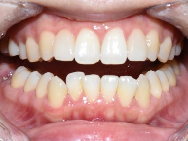 [서울/시청역] 왜소치 라미네이트 케이스 사례/비용/알려드려요 관련 이미지 5