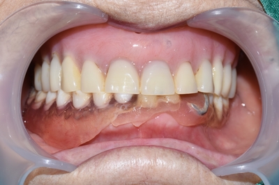 남대문시장가까운치과, 명동,서울역&용산가까운치과, 틀니치료 사례 관련 이미지 20