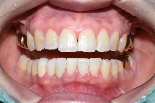 벌어진 앞니 교정치료 & 오래된 앞니 브릿지 다시하기 관련 이미지 7