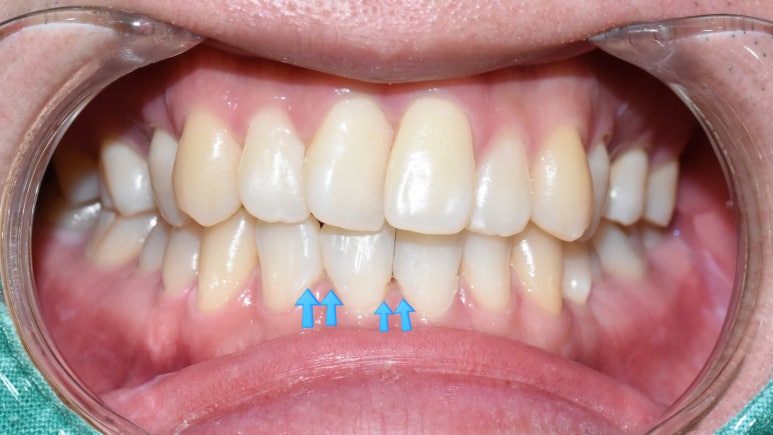 "아래 앞니 벌어진 틈 레진 하고 싶어요" &rarr;치료후 "(감쪽같아서) 어디를 했는지 모르겠어요" 관련 이미지 8