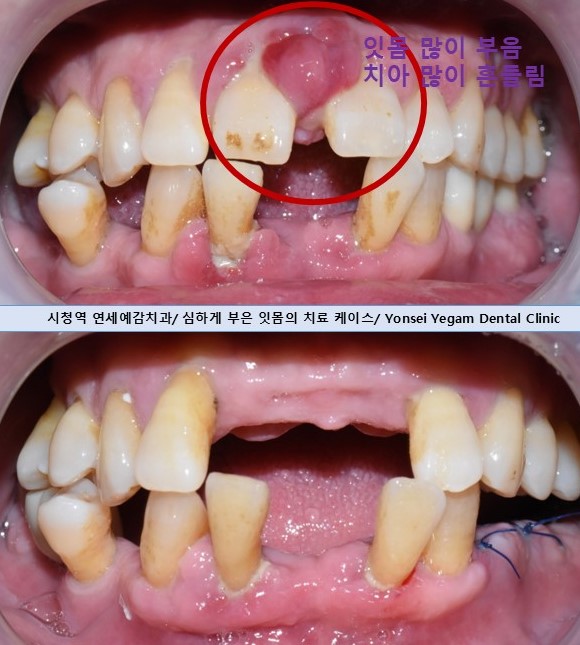 시청역 치과 잇몸치료 케이스 관련 이미지 8