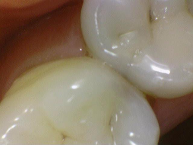 시청역치과 충치치료, 많이 썩었을 때? 신경치료에 대해 알아보아요 관련 이미지 2