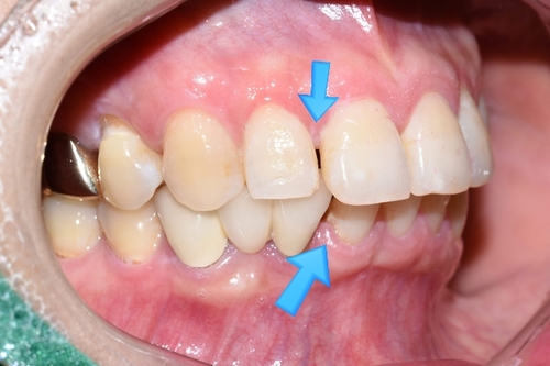 벌어진 앞니 교정치료 & 오래된 앞니 브릿지 다시하기 관련 이미지 2
