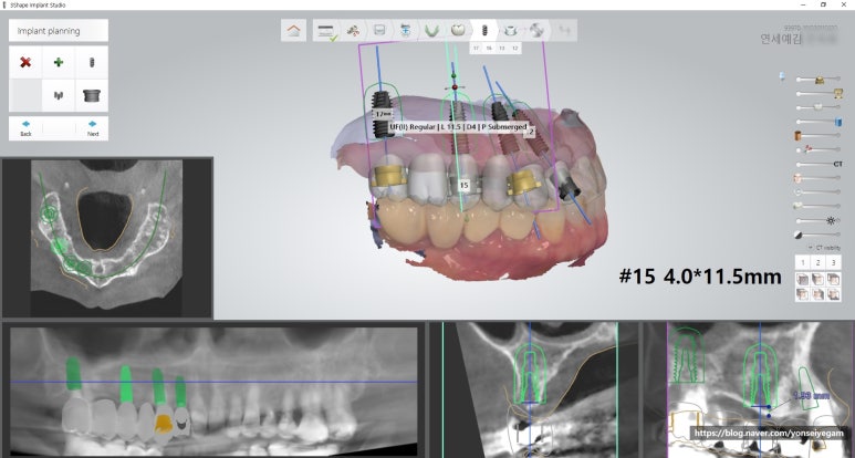 [시청역/서울역]네비게이션인플란트를 이용한 여러개 임플란트 과정 관련 이미지 4