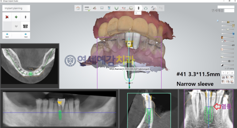 시청역 연세예감치과 디지털임플란트우수시술병원 선정 & 네비게이션 임플란트 관련 이미지 4