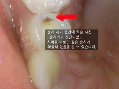 충정로 치과 인레이 해야한다고 들었는데 충치가 안보여요 관련 이미지 3