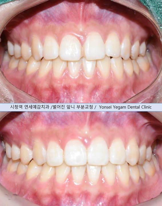충정로 가까운치과 벌어진 치아사이 레진치료 실제사례 알려드려요 관련 이미지 7