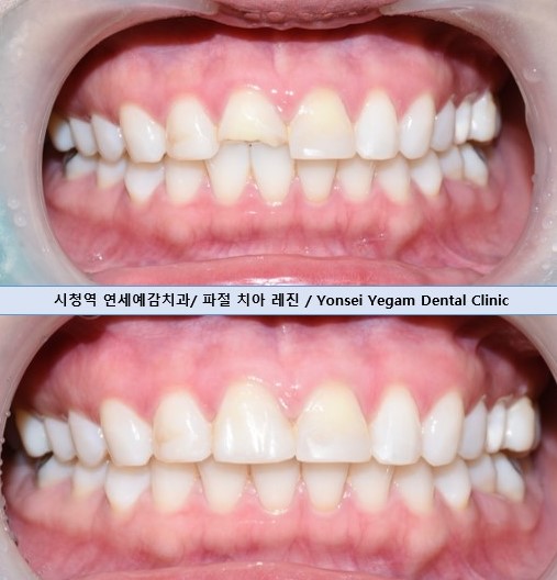 [광화문/연세예감치과] 앞니 치아가 파절되었다면? 앞니 부러짐.레진/크라운/임플란트 관련 이미지 11