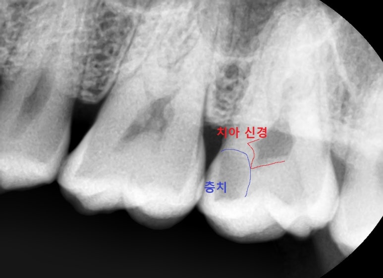 시청역 충정로 충치치료 치과 추천 관련 이미지 13