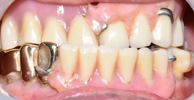 남대문시장가까운치과, 명동,서울역&용산가까운치과, 틀니치료 사례 관련 이미지 18
