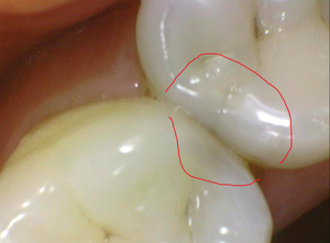 치과의사가 받은 치아치료 & x-ray와 검진의 중요성 관련 이미지 4