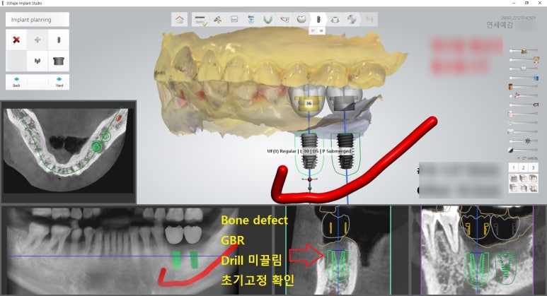 충정로 서울역 근처 고난도 & 재수술 임플란트 수술 치과 관련 이미지 11