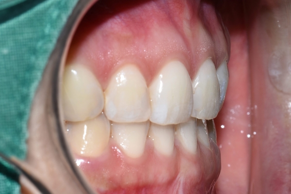 [시청역/광화문]옥니 무삭제라미네이트 전후 소개 및 이벤트 가격안내 관련 이미지 4