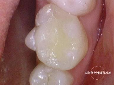 충정로 치과 인레이 해야한다고 들었는데 충치가 안보여요 관련 이미지 9