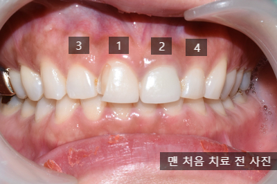 [시청역/광화문]라미네이트케이스:"치아가 작아서 옹졸해 보여요. 치아가 길어보이면 좋겠어요" 관련 이미지 5