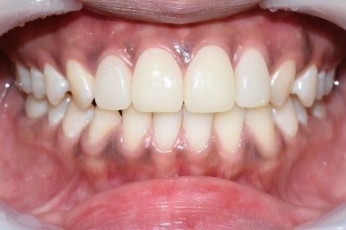 앞니가 작아 고민이신가요? 왜소치 무삭제 라미네이트로 자연스럽게 해결! 해외에서도 찾아오는 치과 비용까지 관련 이미지 9