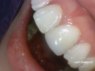 깨진 치아 레진치료 방법 실제사진 관련 이미지 3