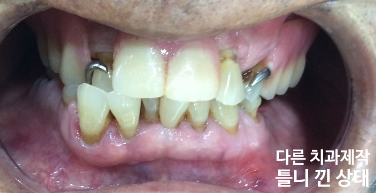 [시청역/서울역/광화문] 전체 임플란트 사례사진, 틀니대신 임플란트 관련 이미지 3